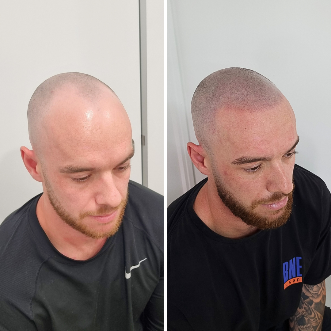 Hair-tattoo-hairline-restoration